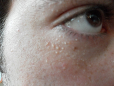 Scars