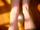 My Fk'ed Up left foot vs. the right foot. 