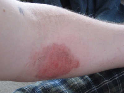 My arm