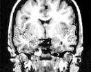 amygdala amygdala