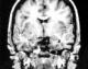 amygdala