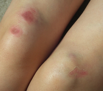 Day 1 - Post-Treatment