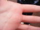 Ben's blister
