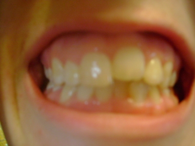 My 21 year old teeth