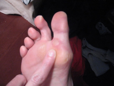 Blister