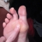 Blister
