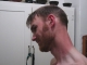 Sunburn