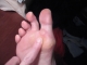 Blister