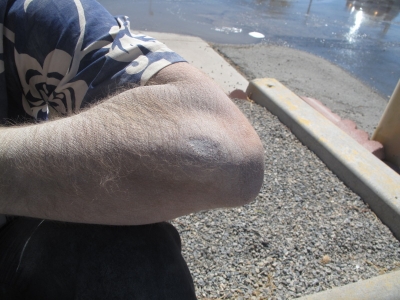 My wound from falling