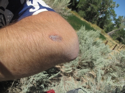 Fall wound post bath