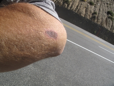 Wound getting better