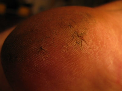 Heel crack Heel crack