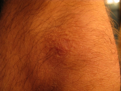 Knee scar Knee scar