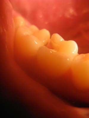 Hole in my tooth Hole in my tooth