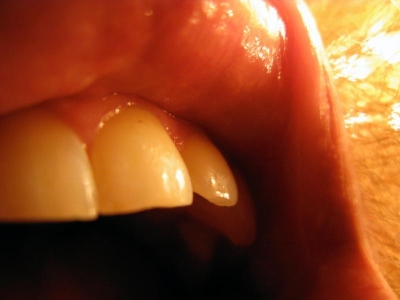 Top teeth Top teeth