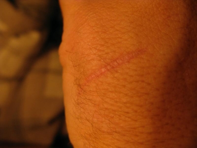 Doorhenge scar Doorhenge scar