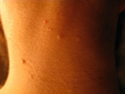 Back of neck Back of neck