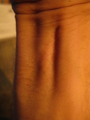 Scar Scar