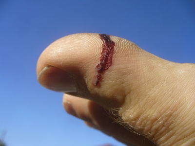 Wound.