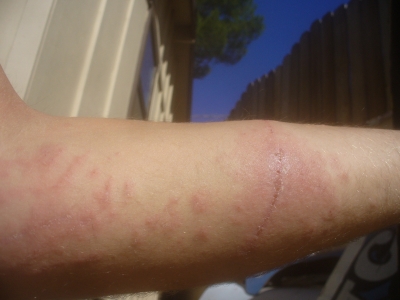 Horrible infection