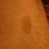 Birth mark