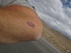 My crash wound