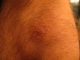 Knee scar