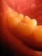 Hole in my tooth