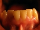 Bottom teeth