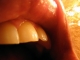 Top teeth