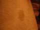 Birth mark