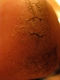 More heel cracks