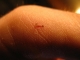 Mystery wound
