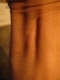 Scar