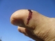 Wound.
