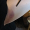 A broom injury.  
