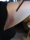 A broom injury.  