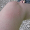The rash from the stinging nettles