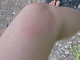 The rash from the stinging nettles