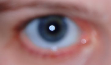 Before. Blue iris, white sclera.