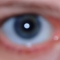 Before. Blue iris, white sclera.