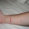 My wound