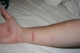 My wound