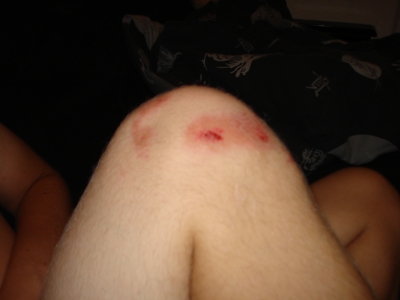 battle scars
