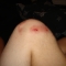 battle scars