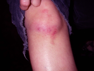 knee-day1.jpg knee-day1.jpg