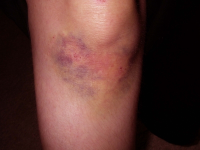 knee-day5.jpg knee-day5.jpg