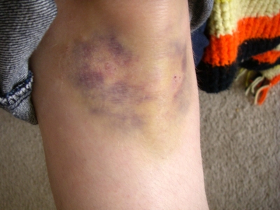 knee-day6.jpg knee-day6.jpg