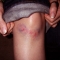 knee-day2.jpg