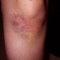 knee-day5.jpg